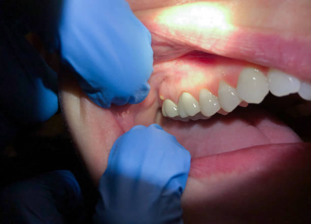 Best Emergency Tooth Extraction in Elsberry, MO